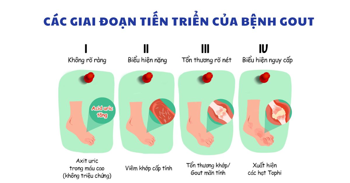 Triệu chứng điển hình của bệnh gout